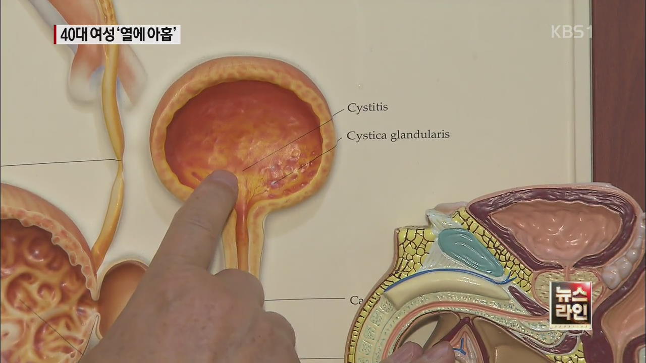 “방광염 환자 94%가 여성…40대 이상 조심”