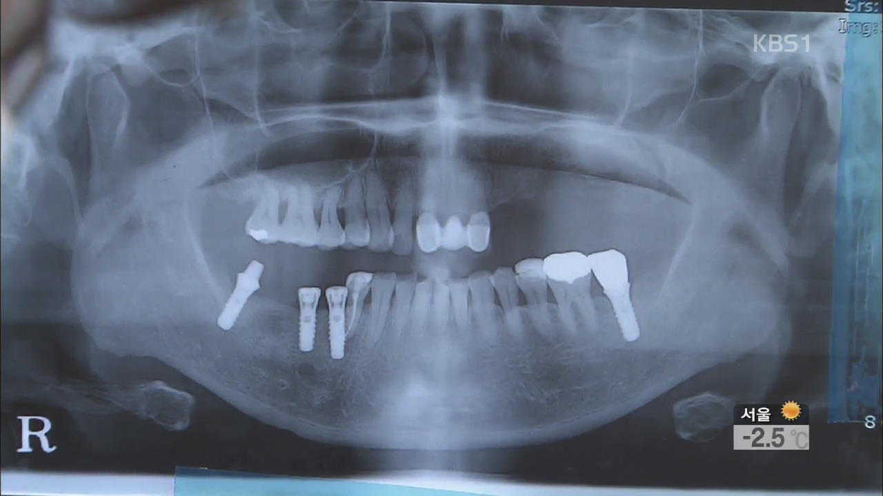 임플란트도 ‘건강보험’ 적용…본인 부담 50%