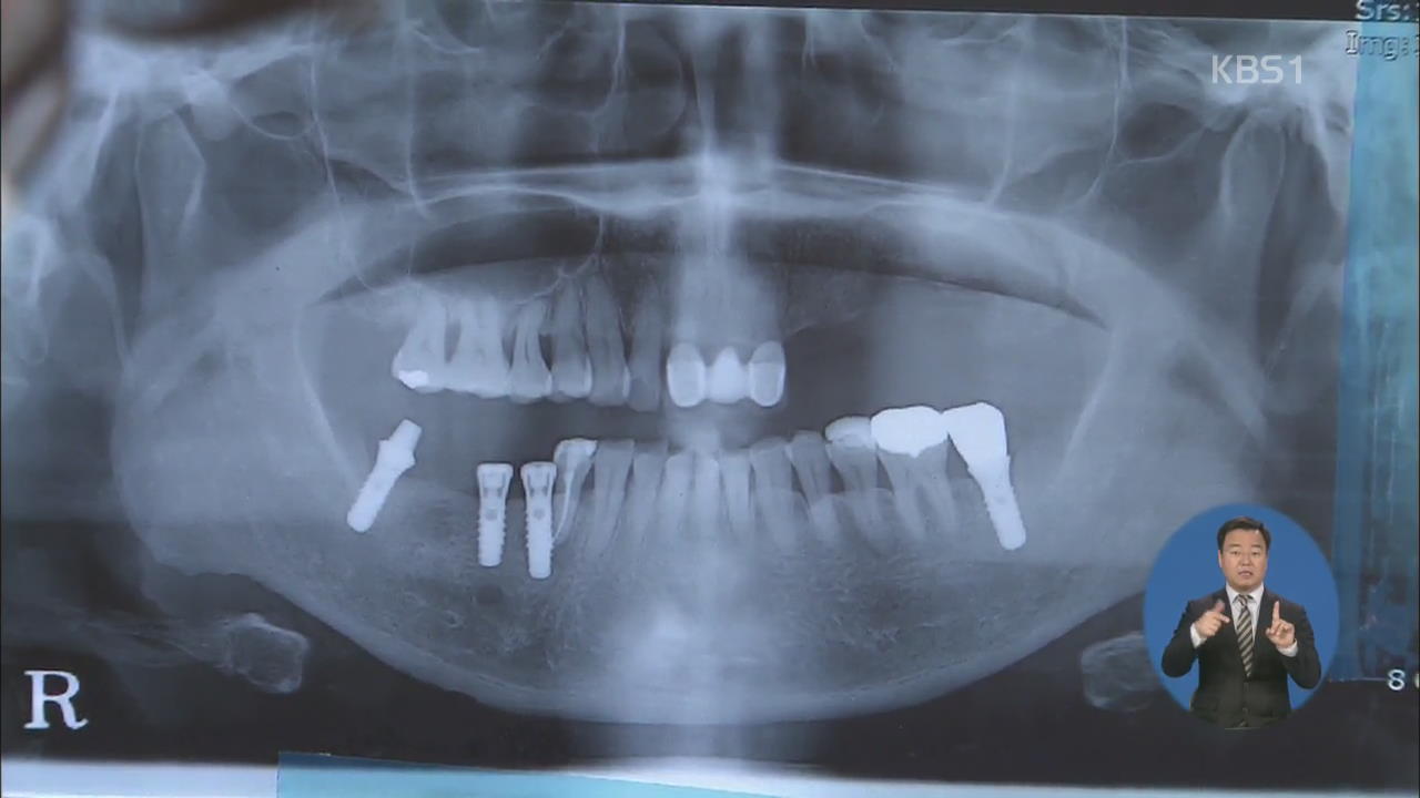 임플란트도 건보 적용…본인 부담율 50%