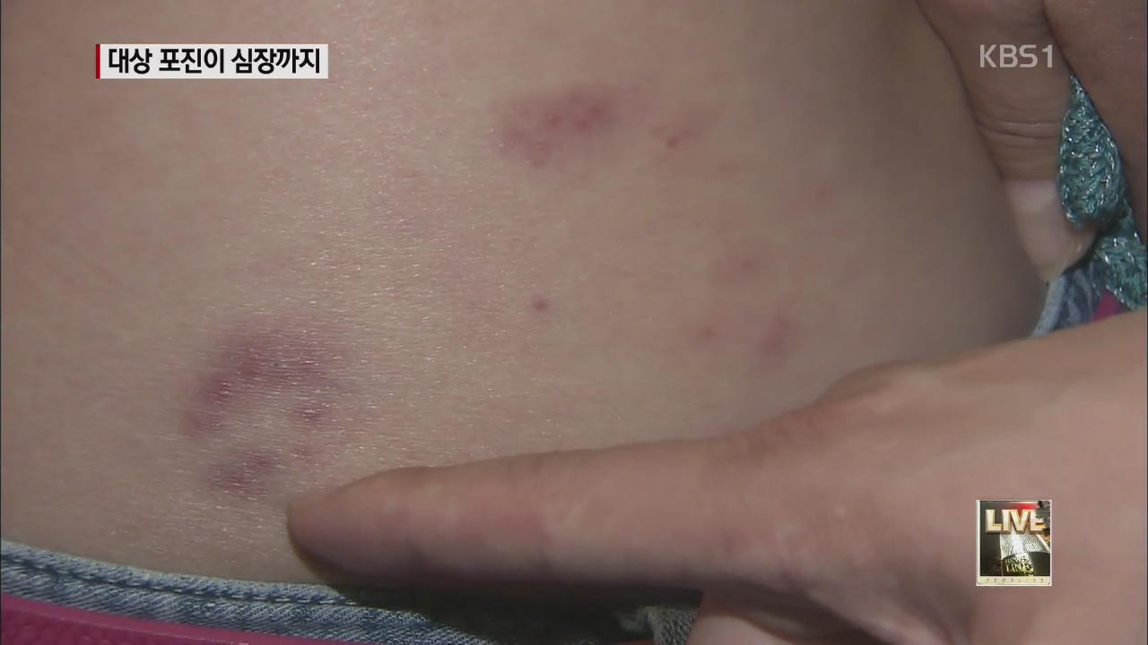 젊을 때 대상 포진, 심혈관질환 발생 위험 높아