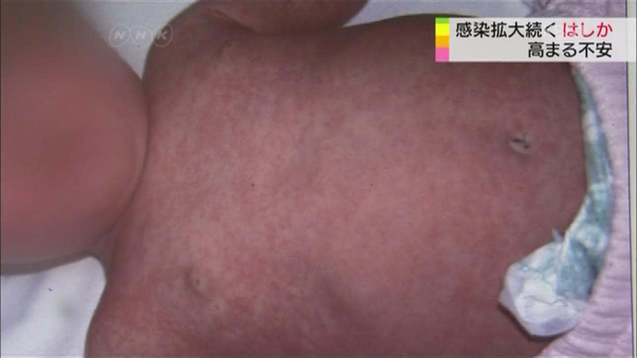 일본, 홍역환자 증가… 해외 감염 많아