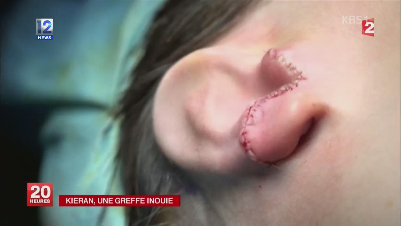 프랑스, 갈비뼈로 만든 인공 귀 이식 성공