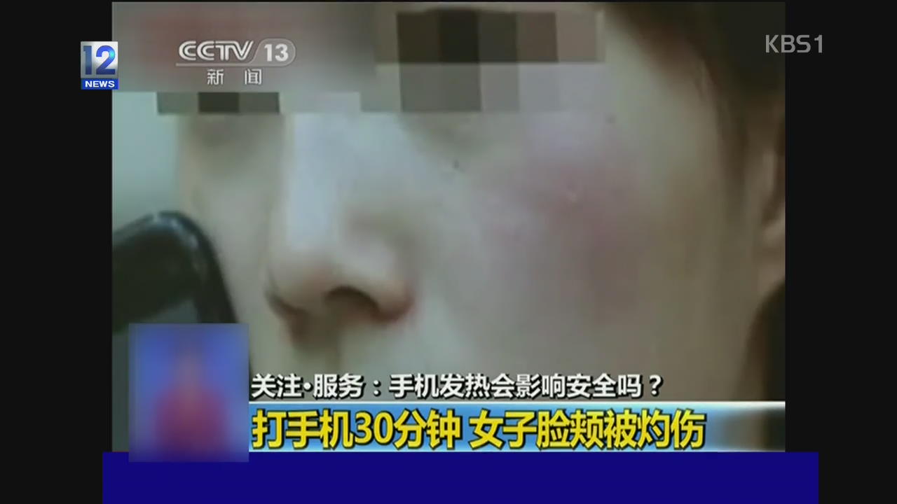 중국, 과열된 휴대전화기에 얼굴 화상까지
