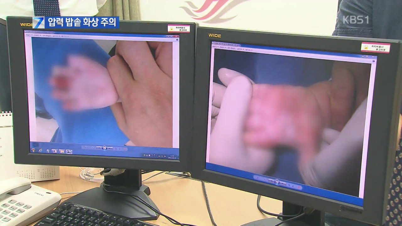 “앗! 뜨거워” 영·유아 압력밥솥 화상 주의보