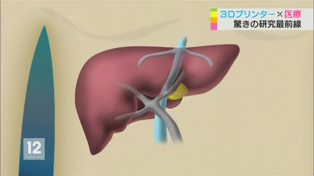 일본, 3D 프린터로 의학 혁명!