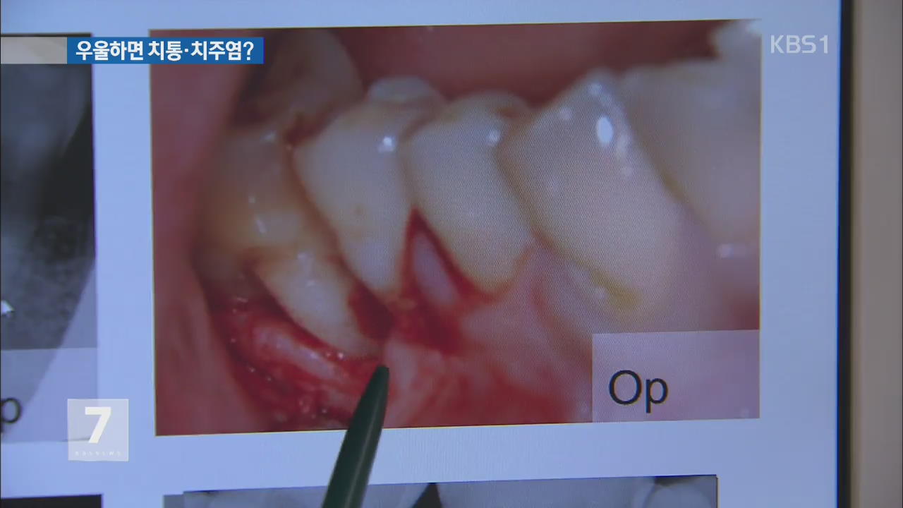 우울증 많이 겪으면 치통·치주염? 치아 건강 위협! 