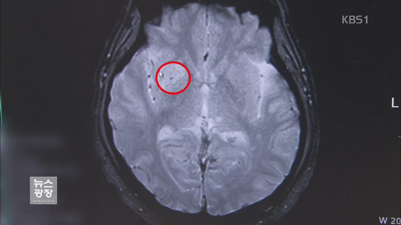 일시 마비 무시했다간…‘마이크로 뇌출혈’ 위험