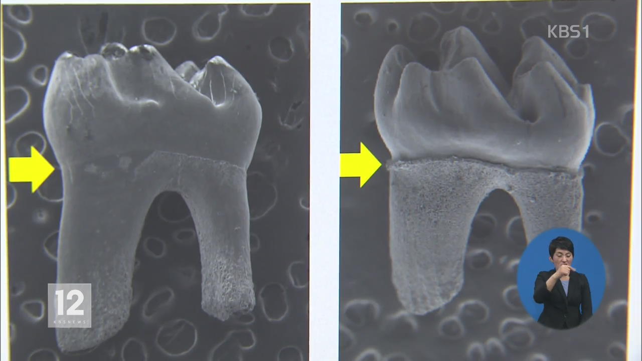 ‘치아뿌리’ 형성 유전자 규명…‘바이오 시대’ 열리나?  