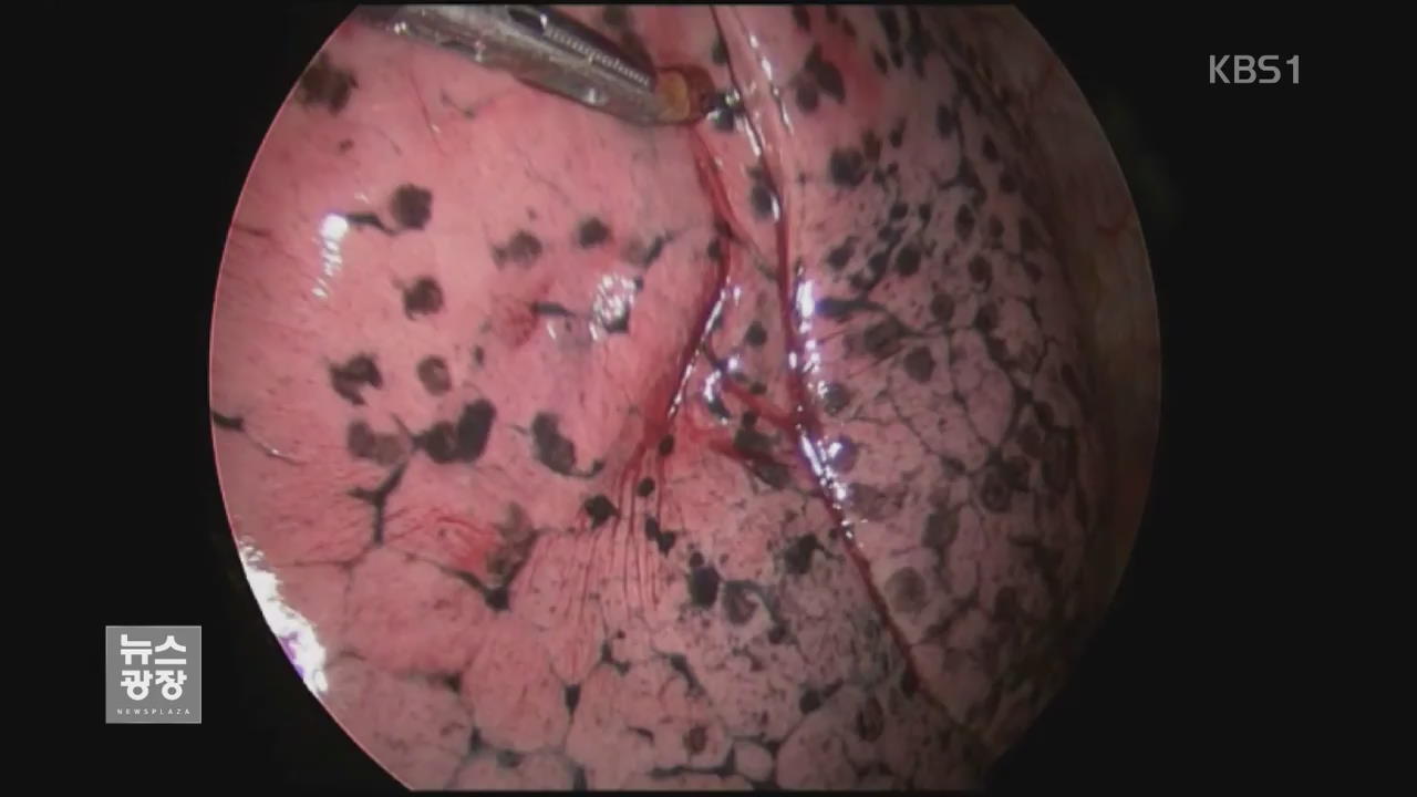 40년간 간접흡연에 노출된 폐 들여다봤더니…