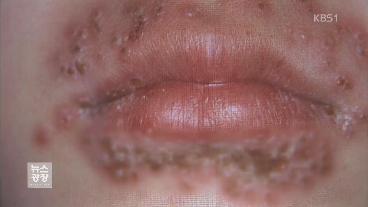 피곤할 때 ‘입술 물집’ 헤르페스 21% ‘10세 미만’