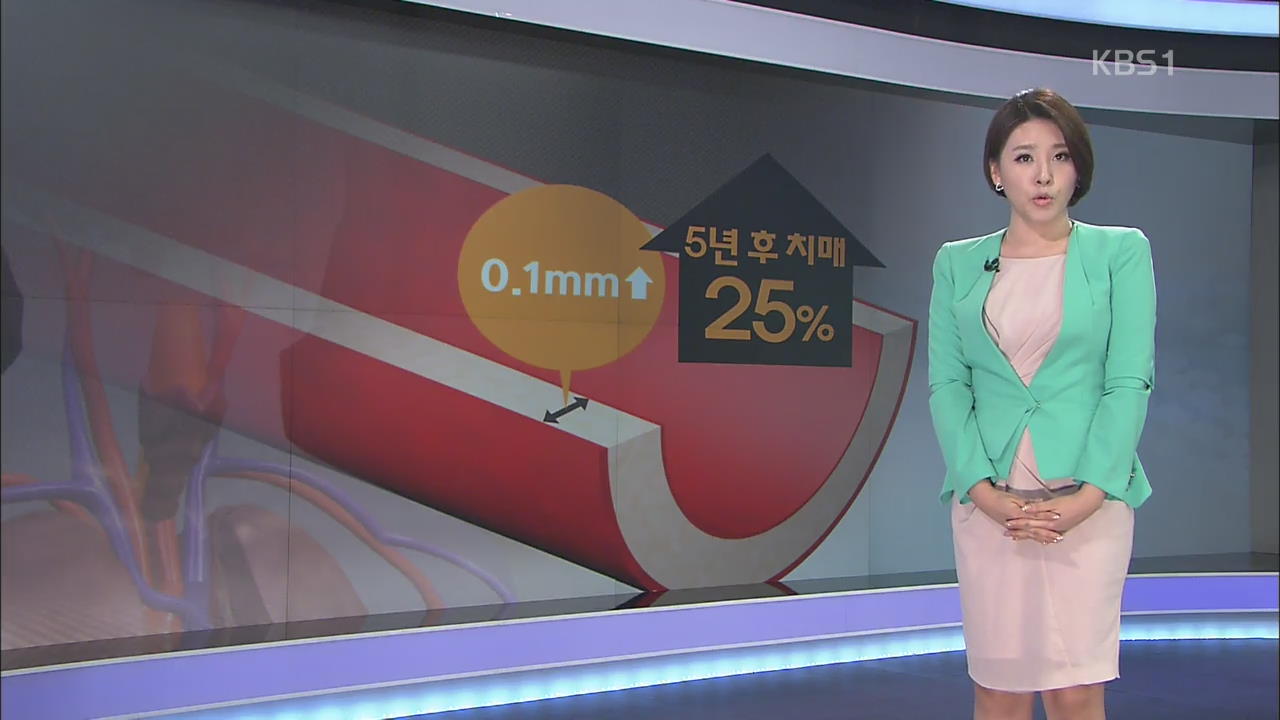 “치매 노인 목 혈관벽 두께, 2배 이상 두꺼워”