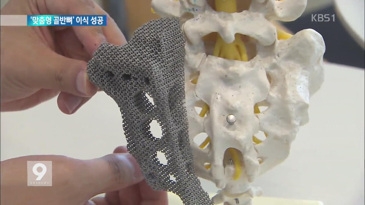 국내서 3D 프린팅 기술로 ‘맞춤형 골반뼈’ 이식 성공