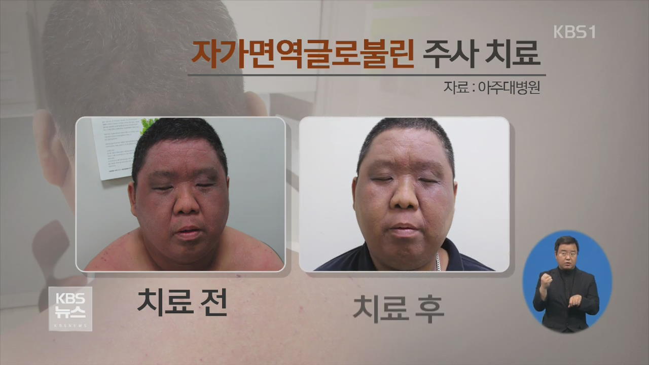 난치성 아토피, 피뽑아 다시 주입했더니…