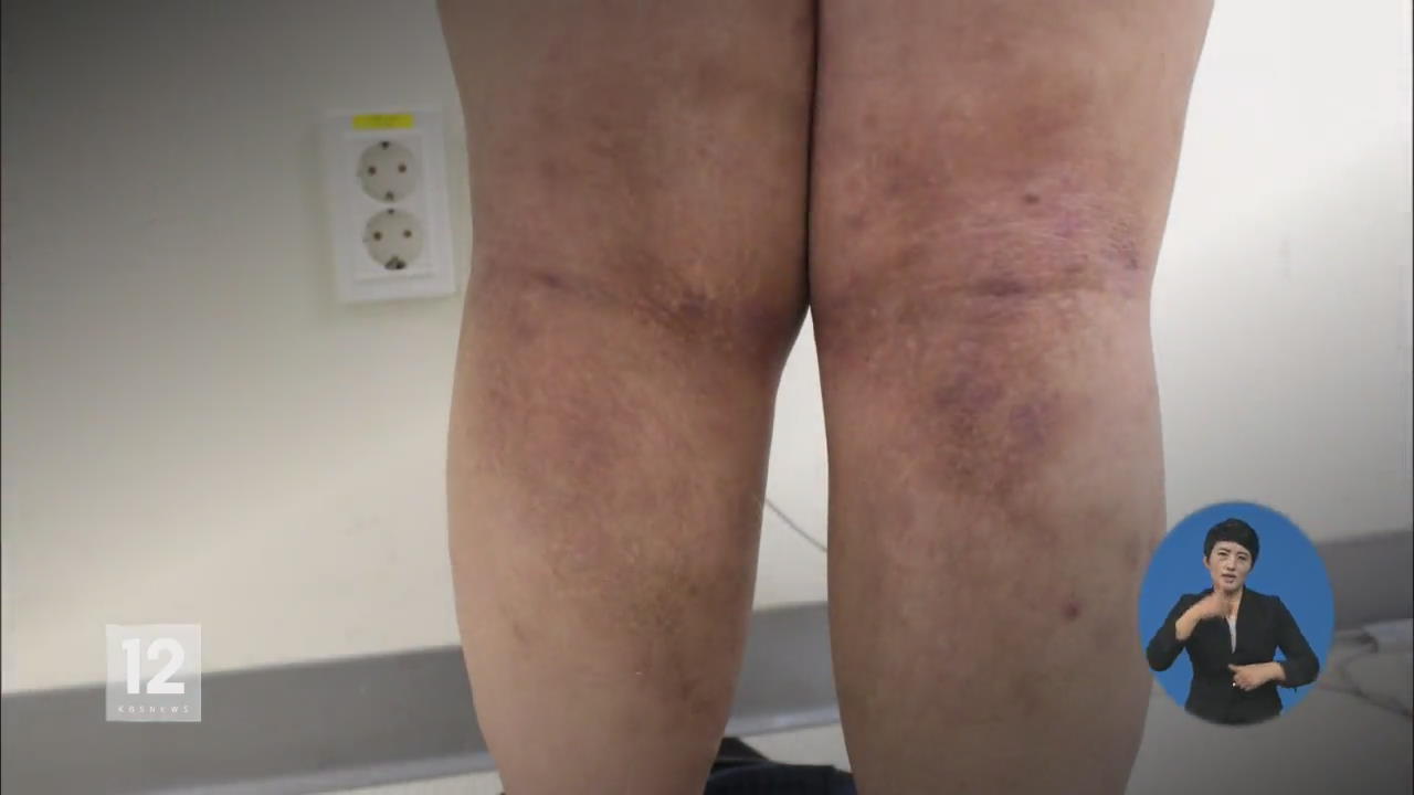 ‘자기 혈액’으로 아토피 치료…효과 높아