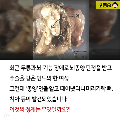 20대 여성의 뱃속에…이런 일이