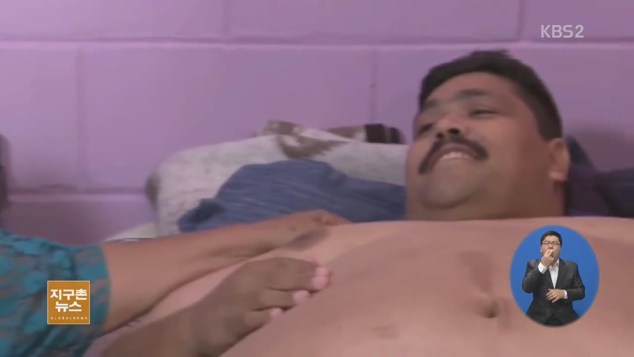 [지구촌 화제의 인물] 세계에서 가장 뚱뚱한 남자, 수술로 제2의 삶
