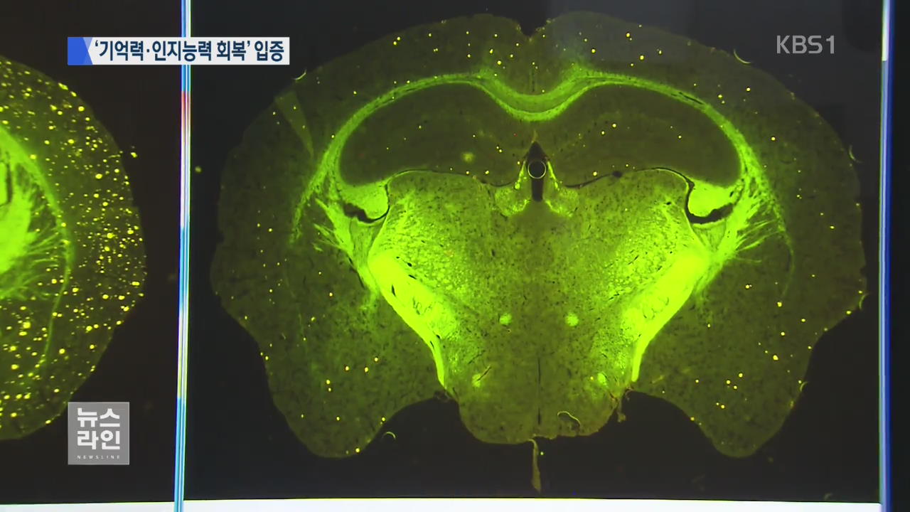 알츠하이머병 치료 길 열다…“물에 타 먹는 신약 물질 개발”
