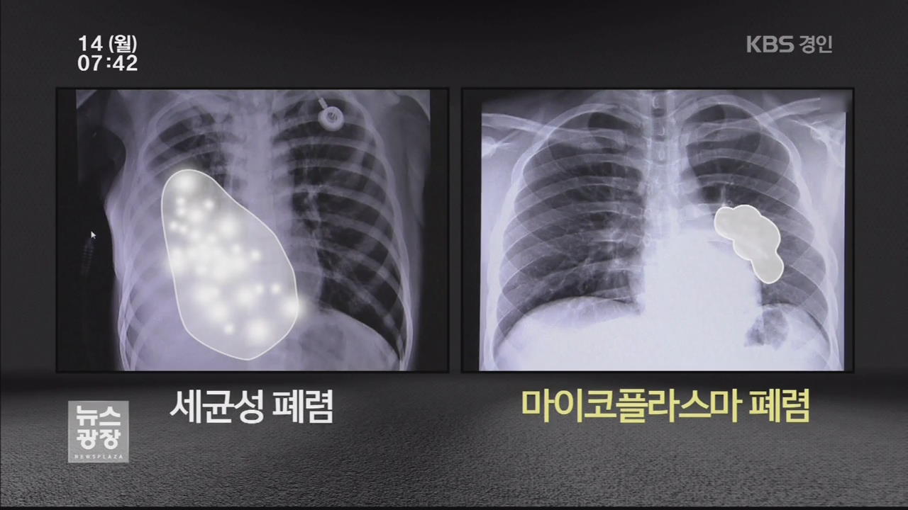 성병이야? 아니야? 마이코플라즈마 질염의 특이점