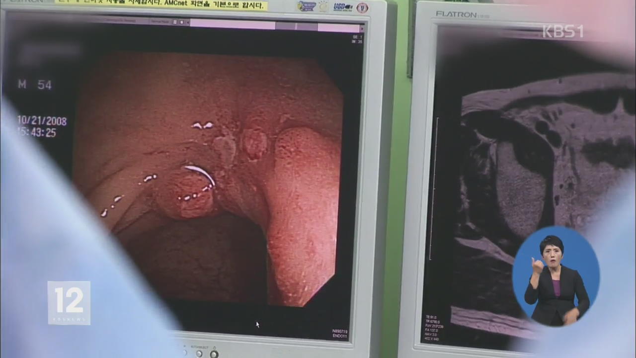대장암 젊을수록 재발 위험…생존율 떨어져