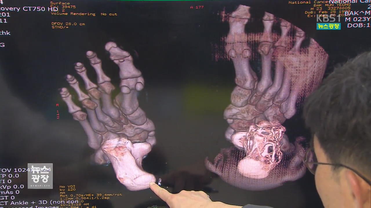 3D 프린터로 발뒤꿈치뼈 국내 첫 복원