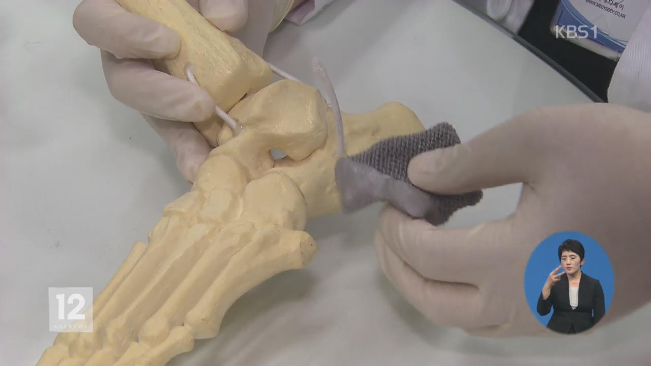 3D 프린터로 발뒤꿈치뼈 국내 첫 복원