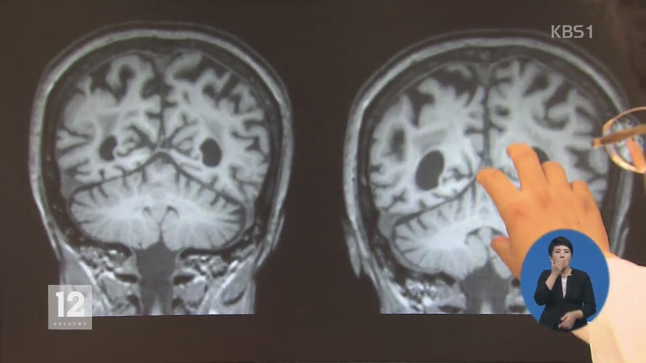 한국형 뇌 지도 완성…치매 치료 ‘청신호’