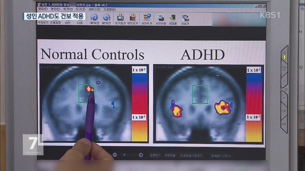성인 ADHD 환자 120만 명…‘건보’ 적용