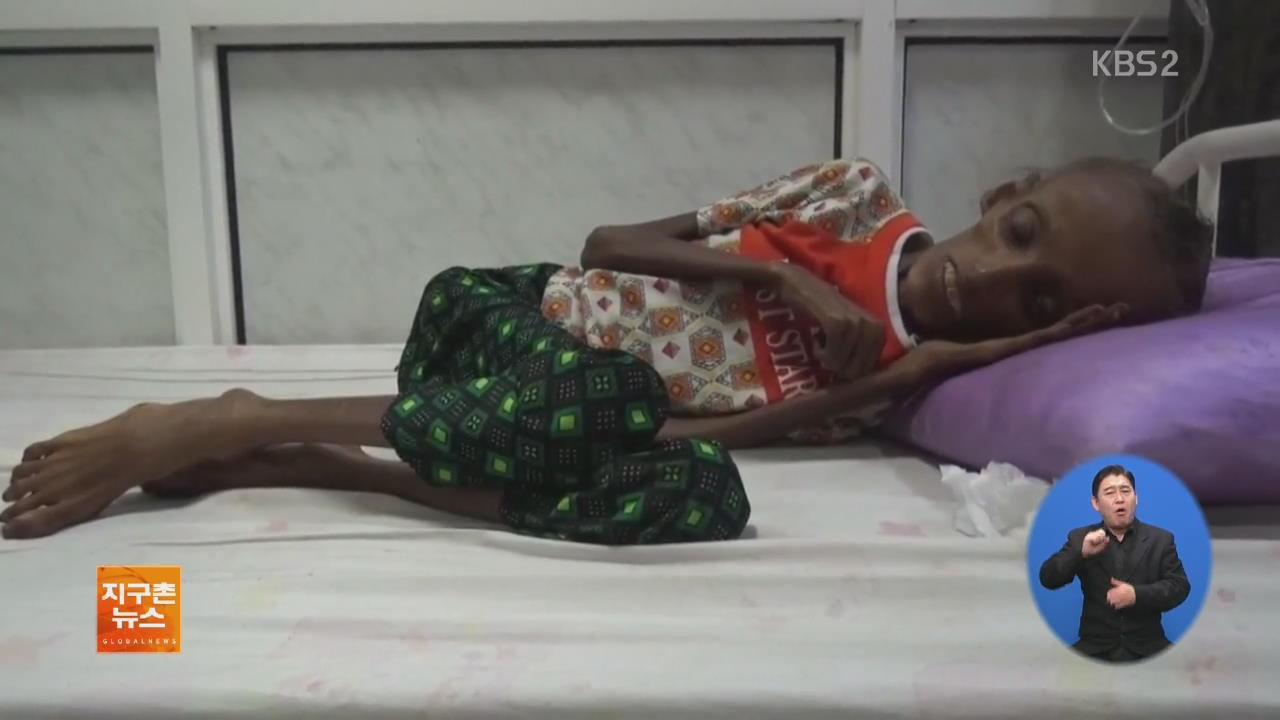 [ABU 세계 창] 내전 예멘, ‘영양실조’ 어린이 37만 명