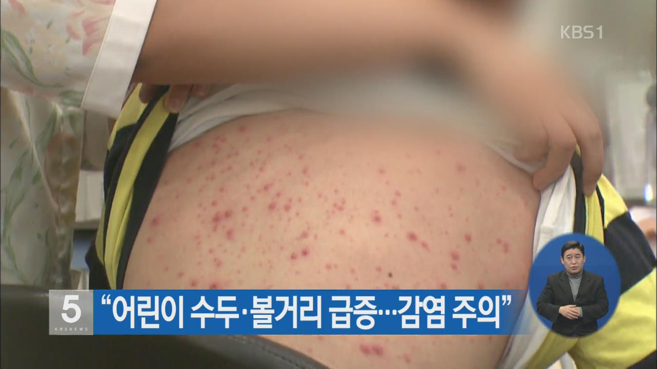 “어린이 수두·볼거리 급증…감염 주의”