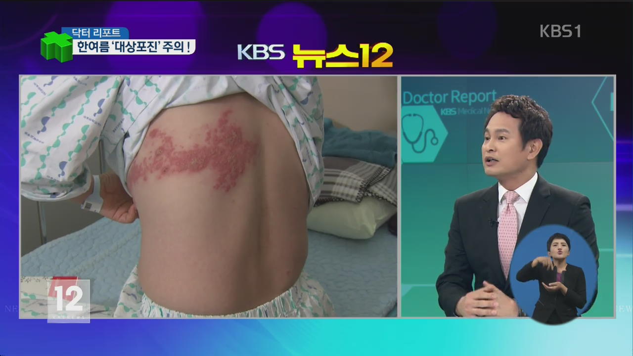 [닥터 리포트] 한여름 ‘대상포진’ 급증…예방·치료법은?