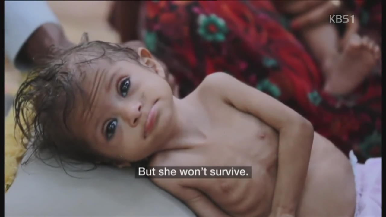 예멘 내전으로 인한 어린이 영양실조 심각