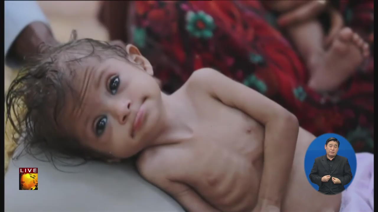 예멘 내전으로 인한 어린이 영양실조 심각