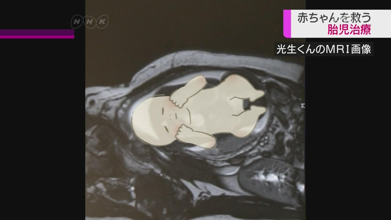 日, 새로운 선택지로 주목받는 ‘태아 치료’