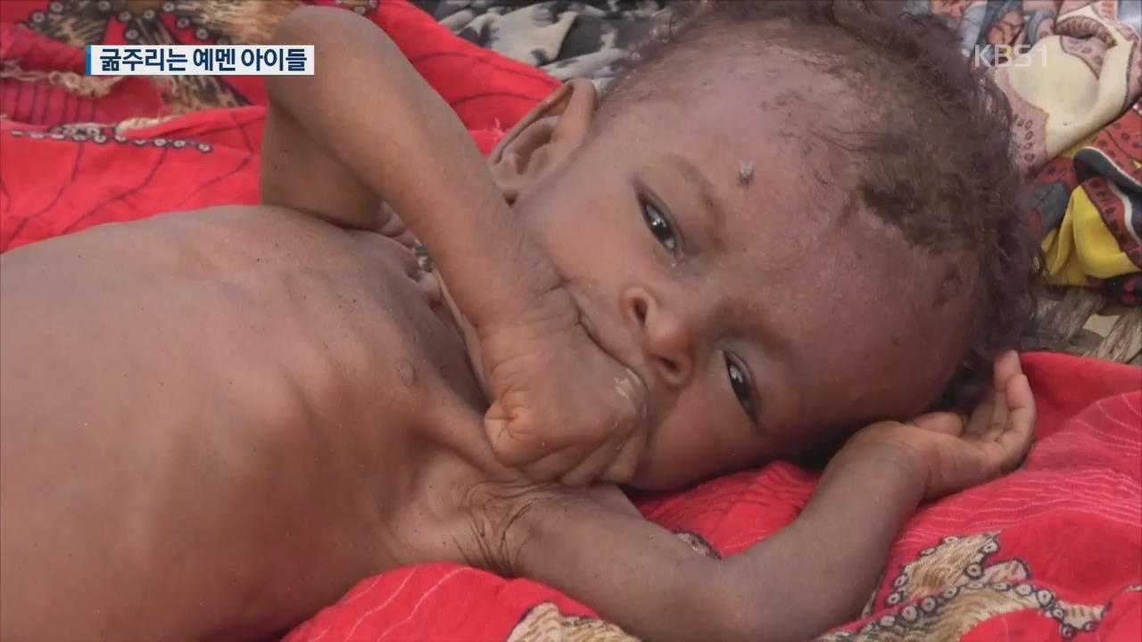 ‘생지옥’ 예멘…어린이 40만 명 굶주림과 사투