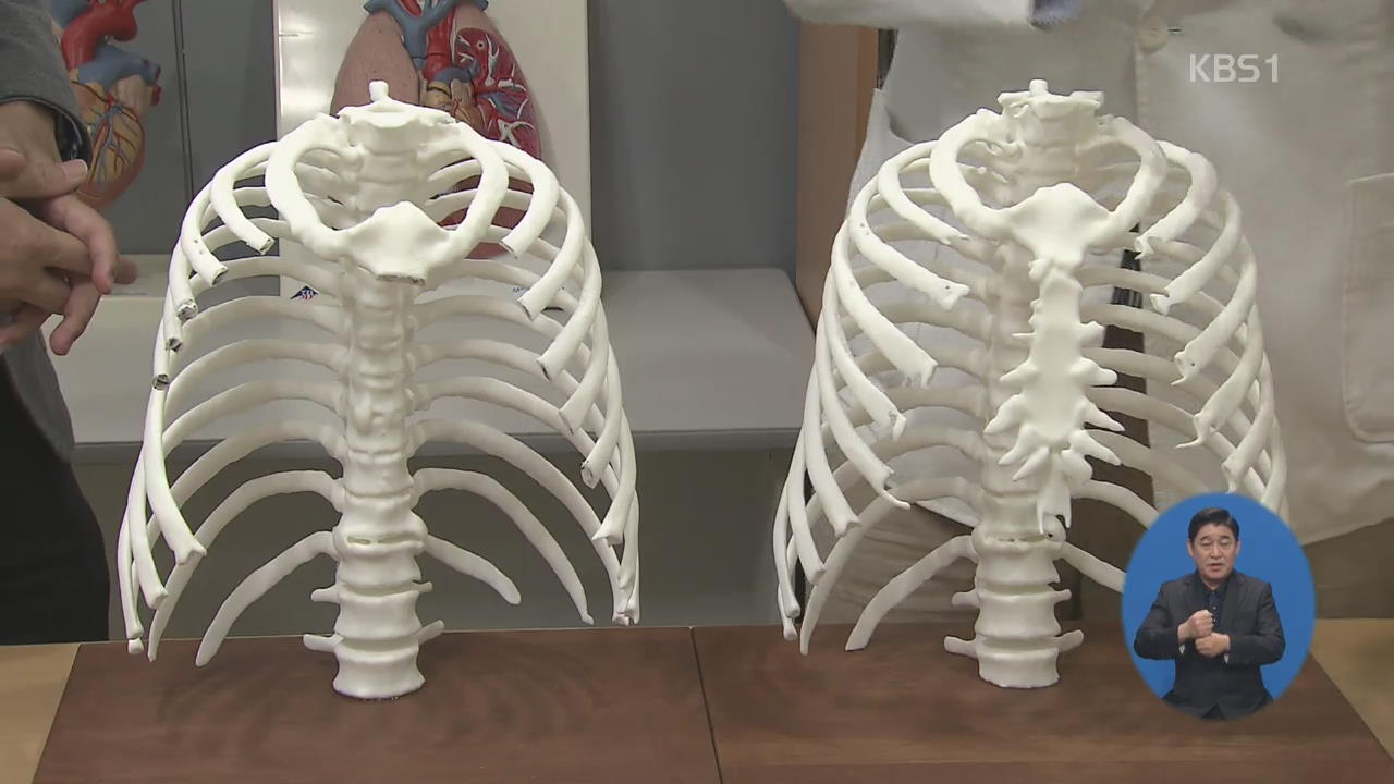 3D프린팅 세계 최대 인공 흉곽 제작…환자이식 성공