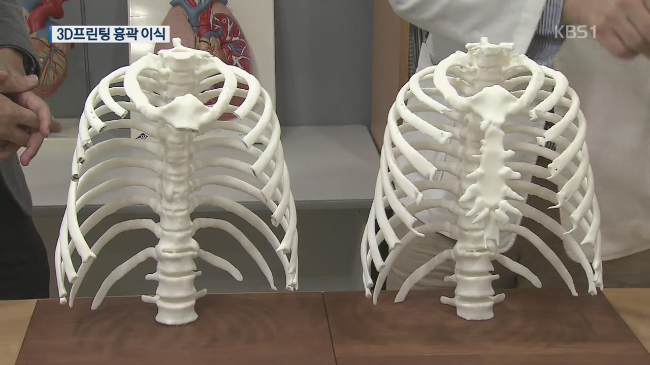 ‘가슴-갈비뼈’도 3D프린팅…국내 첫·세계 최대 이식 성공