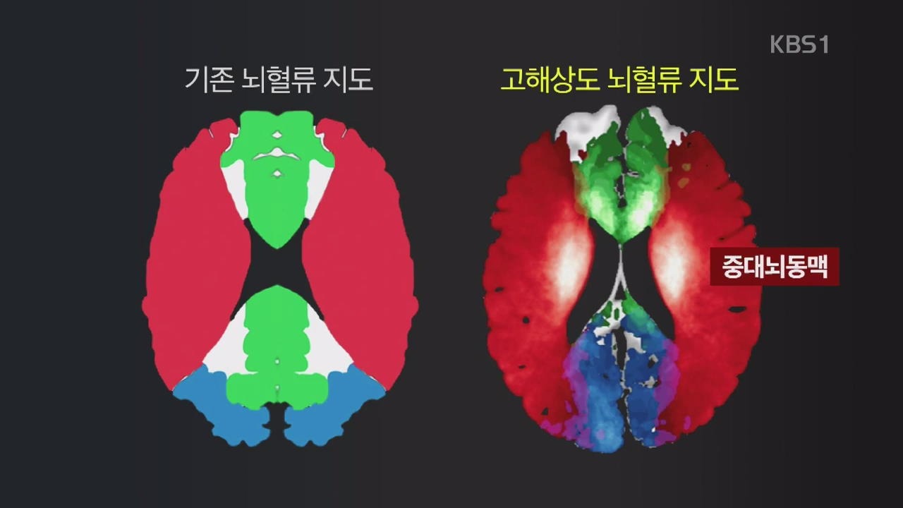 ‘고해상도 뇌혈류 지도’ 최초 완성…“뇌경색 진단 정확도↑”