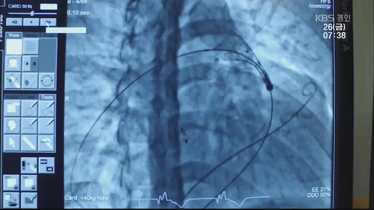 ‘혈관 삽입’ 인공심장판막 세계 최초 개발