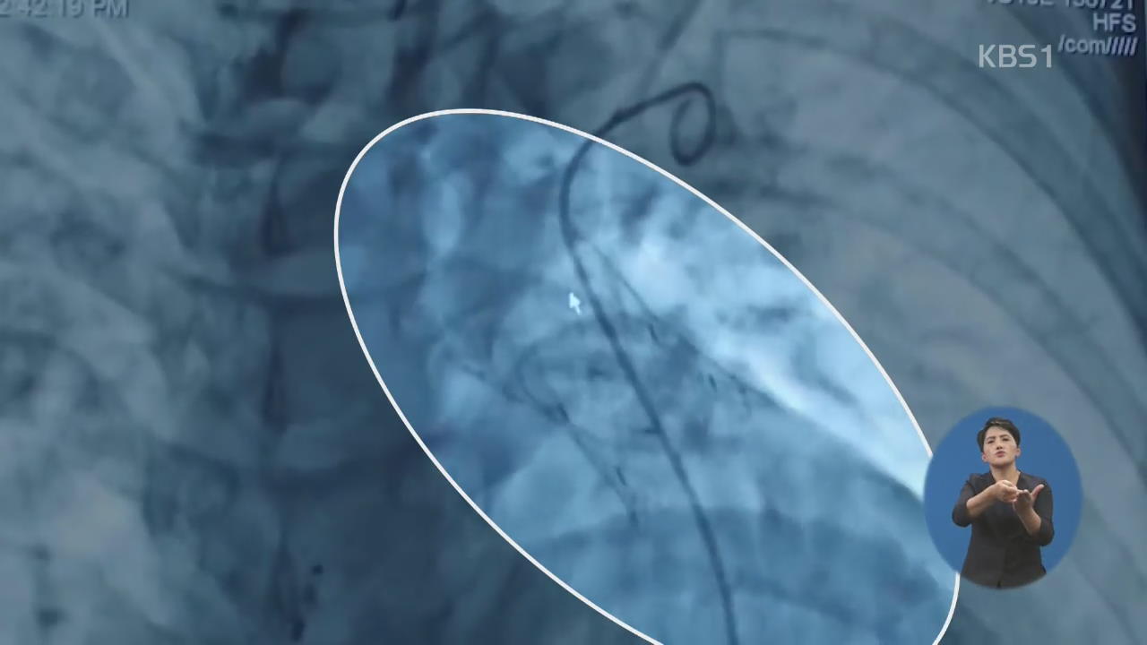 ‘혈관 삽입’ 인공심장판막 세계 최초 개발