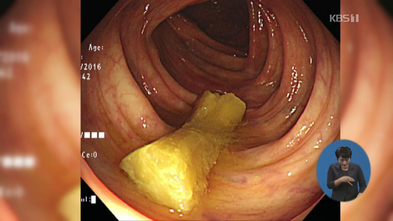 대장내시경 절반은 장 청소 ‘불합격’