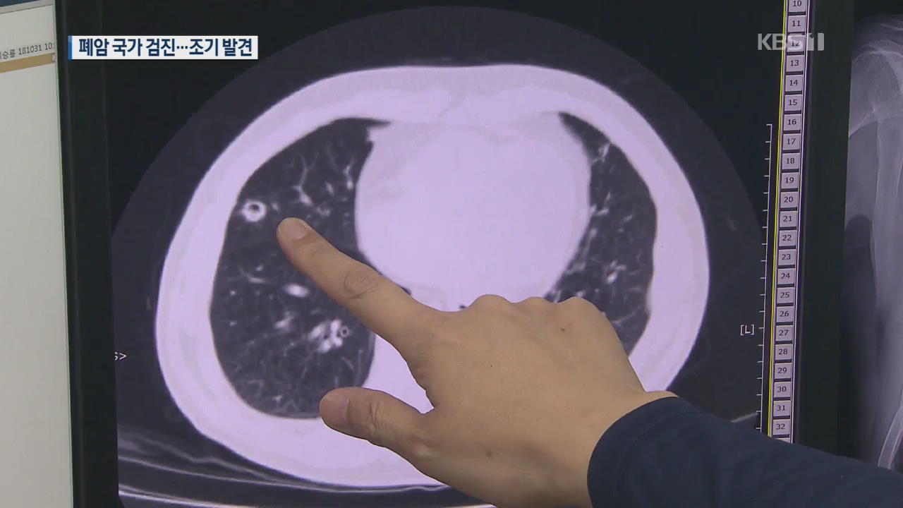 ‘암 사망 1위’ 폐암도 국가검진 시행…조기 발견 돕는다