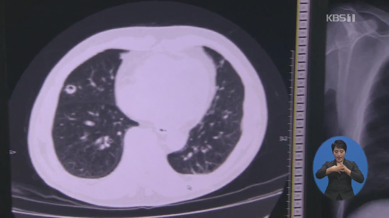 ‘암 사망 1위’ 폐암도 국가검진 시행…조기 발견 돕는다