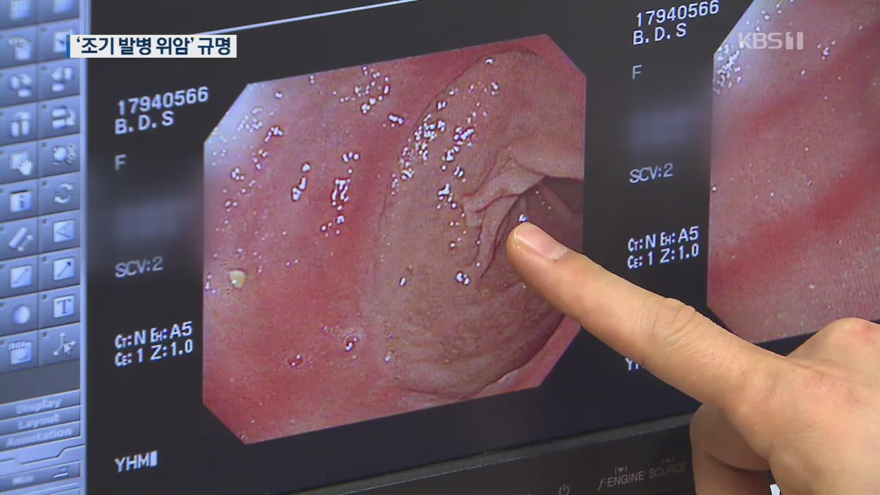 증상 없는 ‘조기발병 위암’…국내 연구진 원인 찾았다