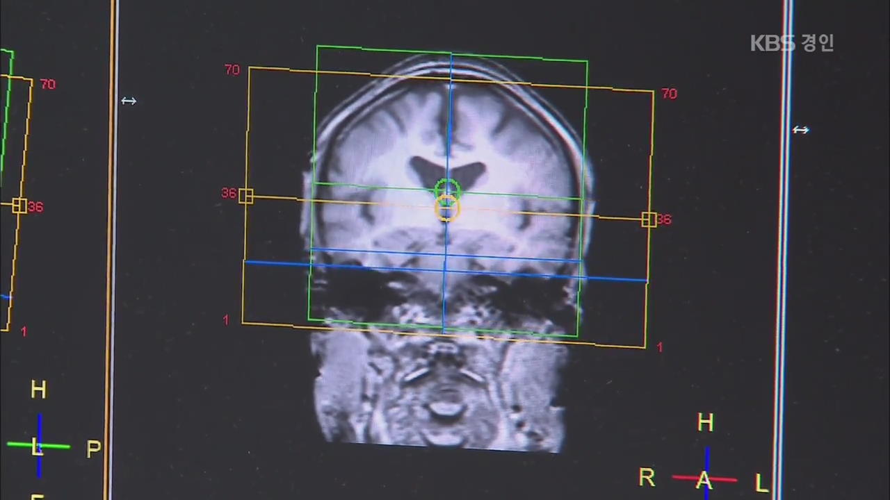 “MRI 판정 없어도 경증 치매 보험금 지급한다”