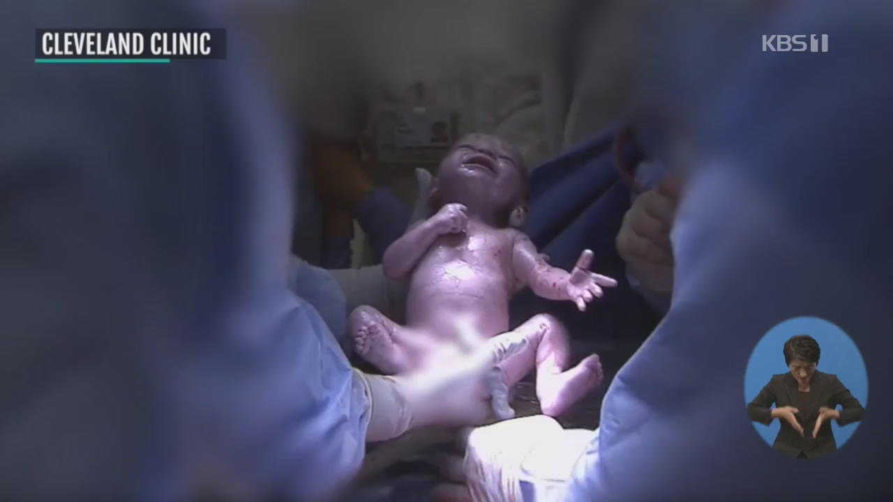 미국, 숨진 기증자의 자궁 이식 출산 성공