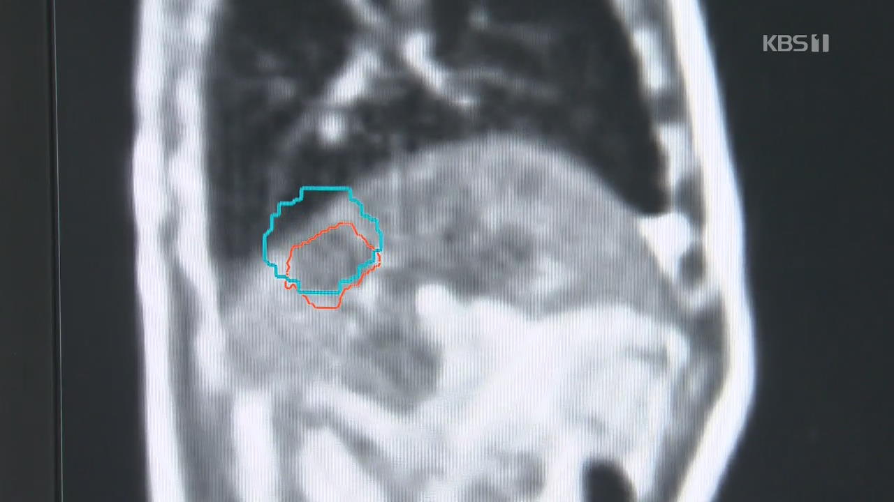 MRI로 위치 추적…“더 정밀하게 암세포만 없앤다”