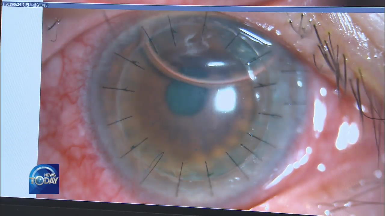 NEW TECHNIQUE FOR CORNEAL TRANSPLANT
