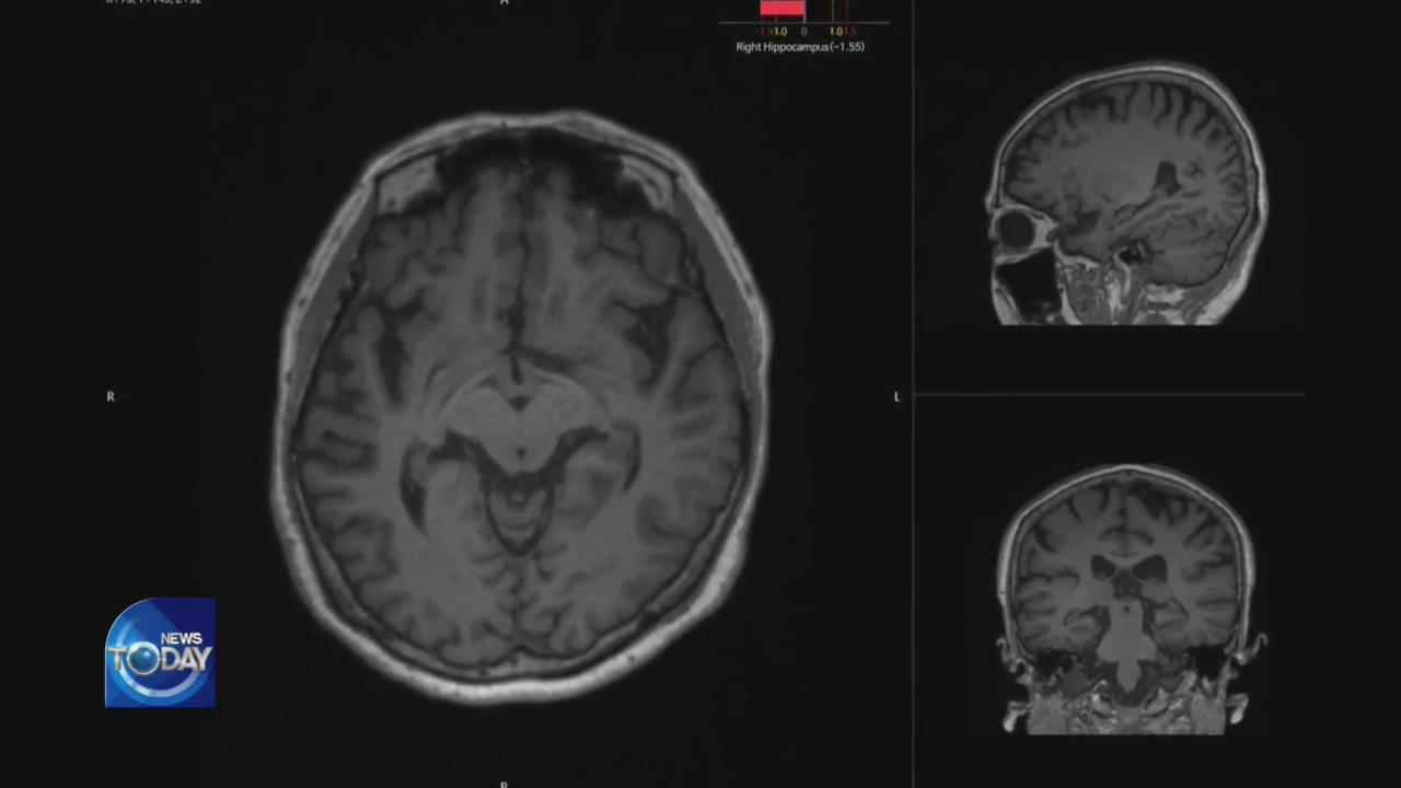 STUDY BEHIND DEMENTIA
