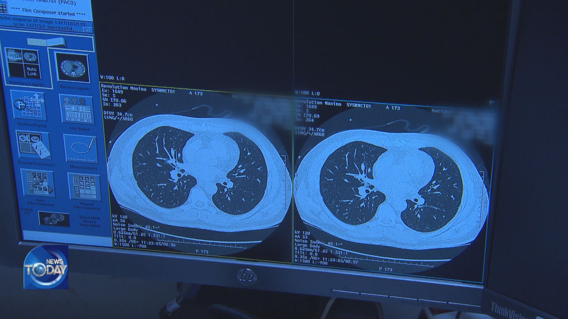 LUNG CANCER FREQUENT AMONG MEN