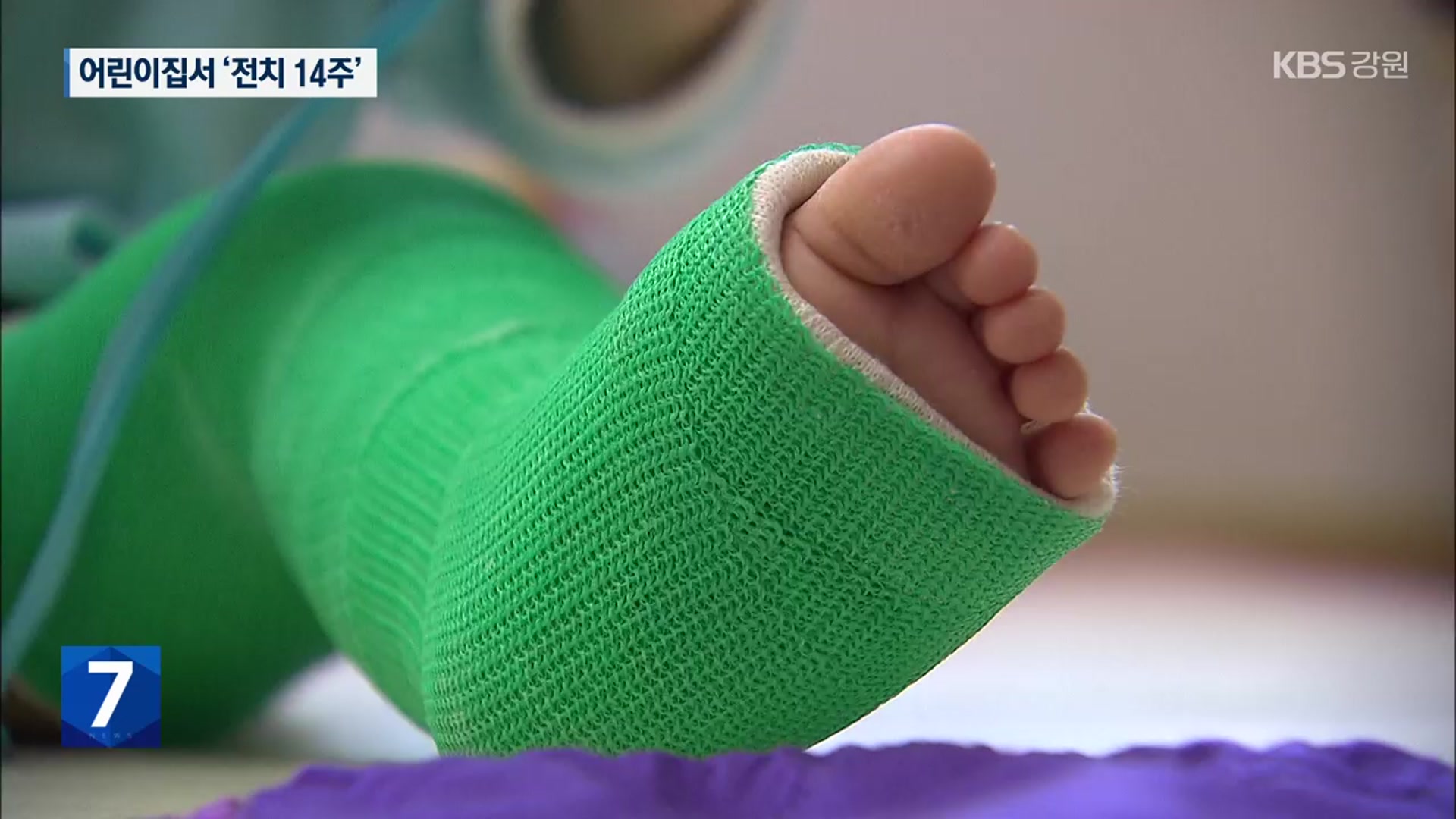 생후 30개월 다리 부러져 ‘전치 14주’…어린이집 “다툼 제지하려”